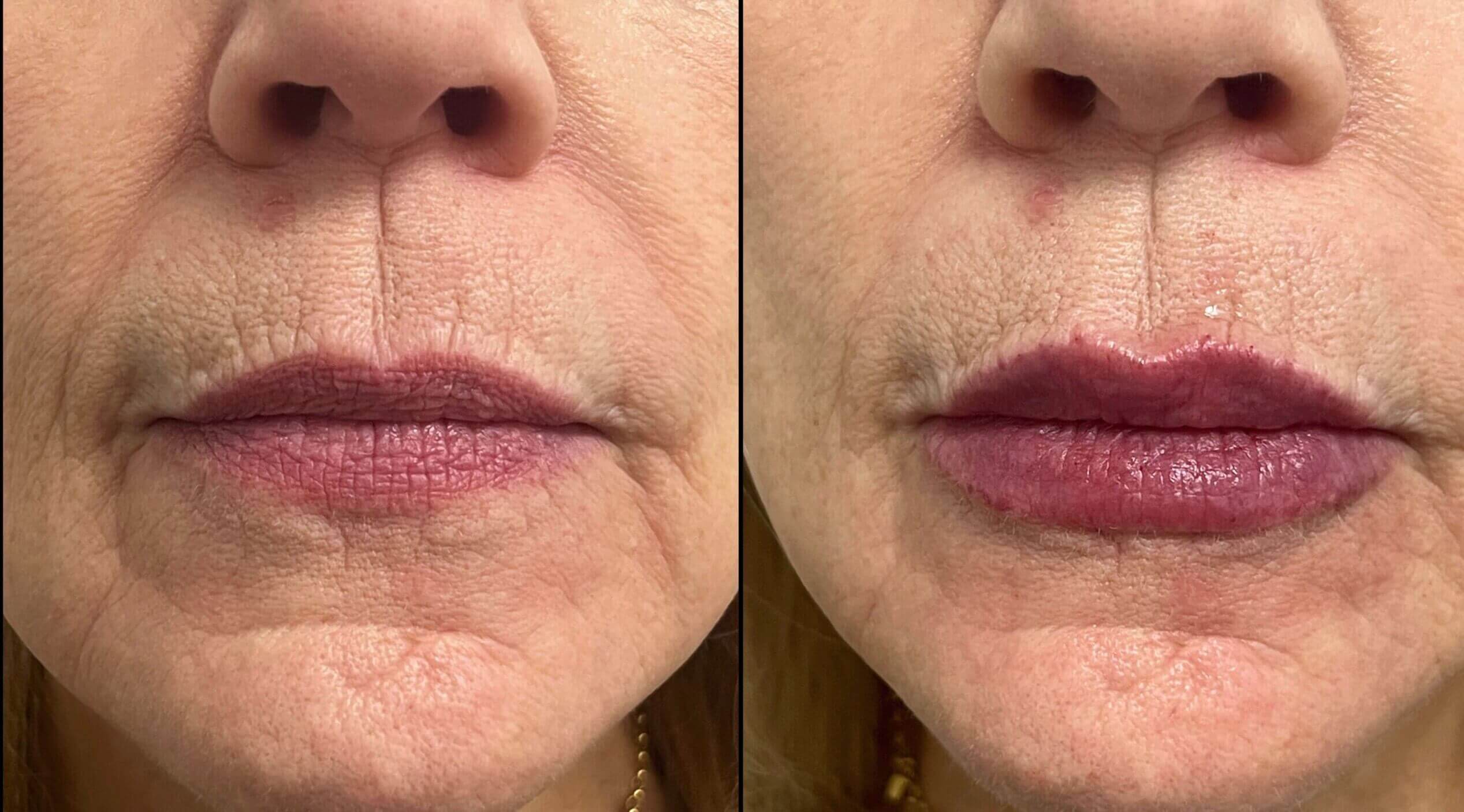 Lip Fillers